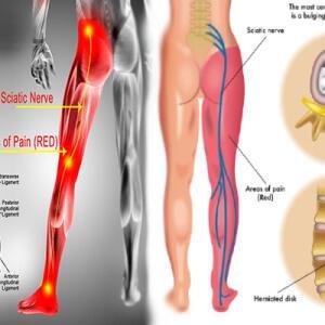 Nerve Pain Treatment Medicine and Supplements for Relief